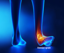 Eversion sprain